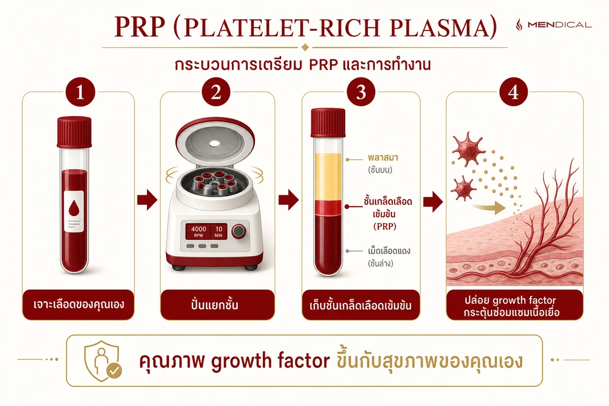 ขั้นตอน PRP: เจาะเลือดของคุณเอง → ปั่นแยกชั้น → เก็บชั้นเกล็ดเลือดเข้มข้น → ปล่อย growth factor กระตุ้นการซ่อมแซมเนื้อเยื่อ